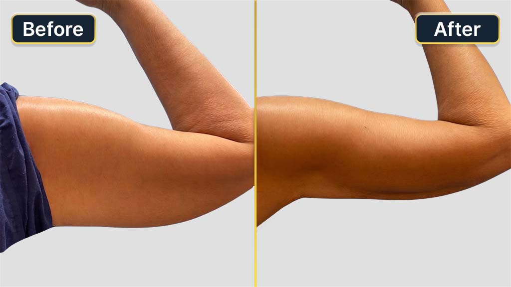 Arm Contouring Before and After