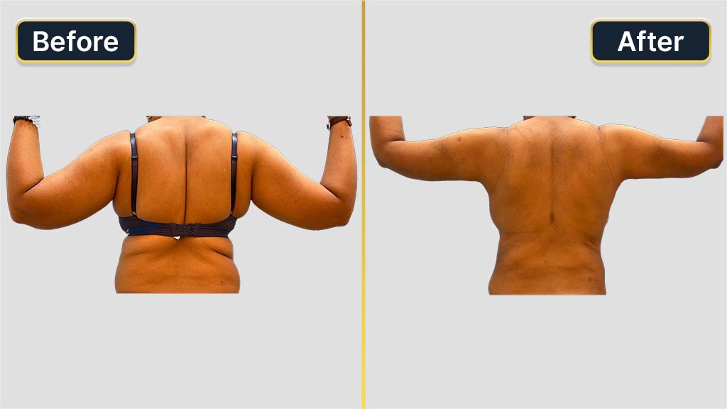 Arm Contouring Before and After