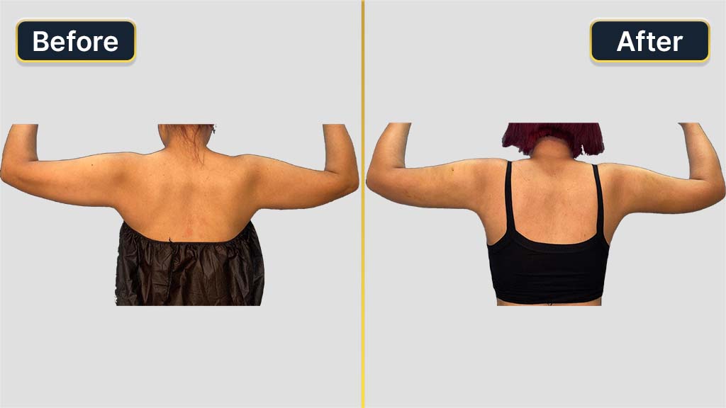 Arm Contouring Before and After