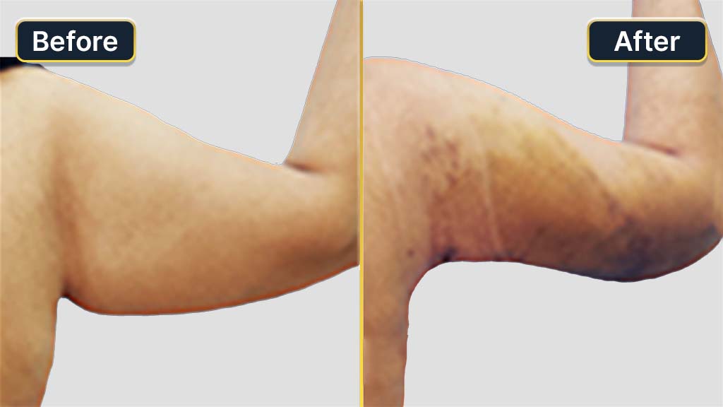 Arm Contouring Before and After