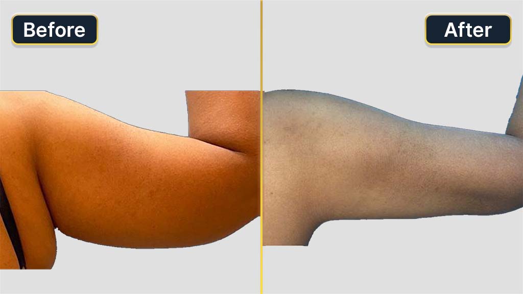 Arm Contouring Before and After