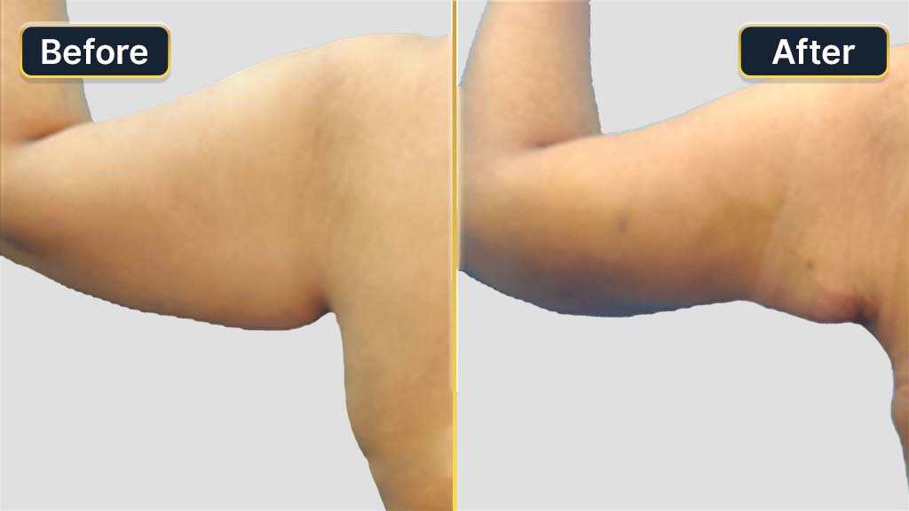 Arm Contouring Before and After