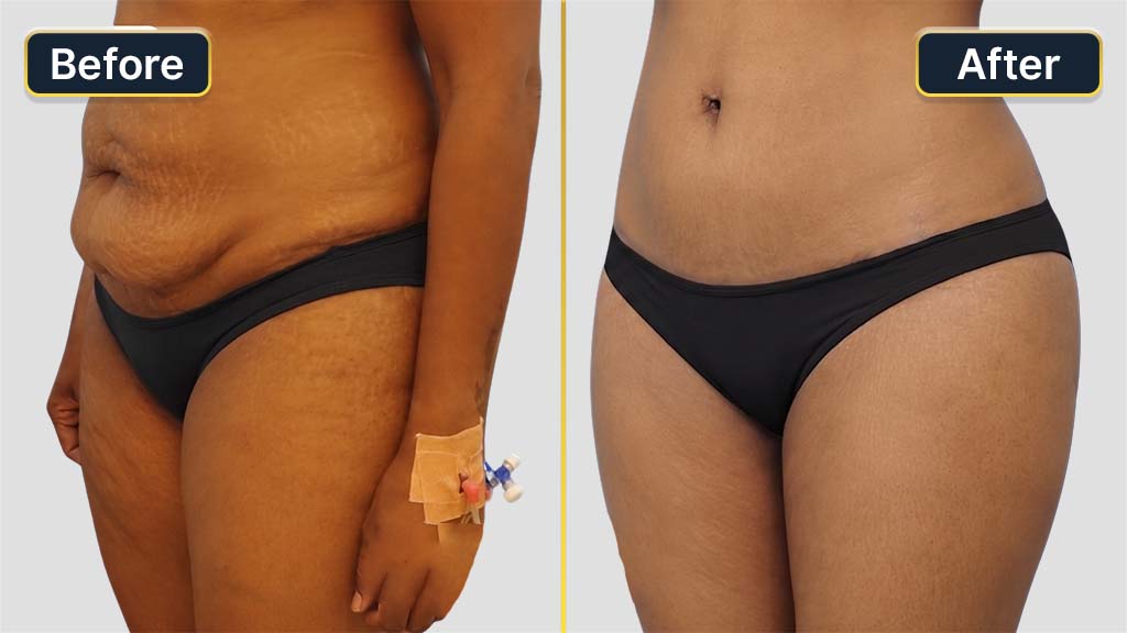 Liposuction Before and After