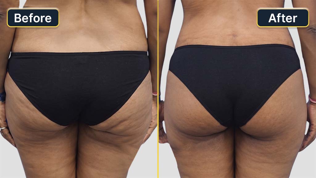 Liposuction Before and After