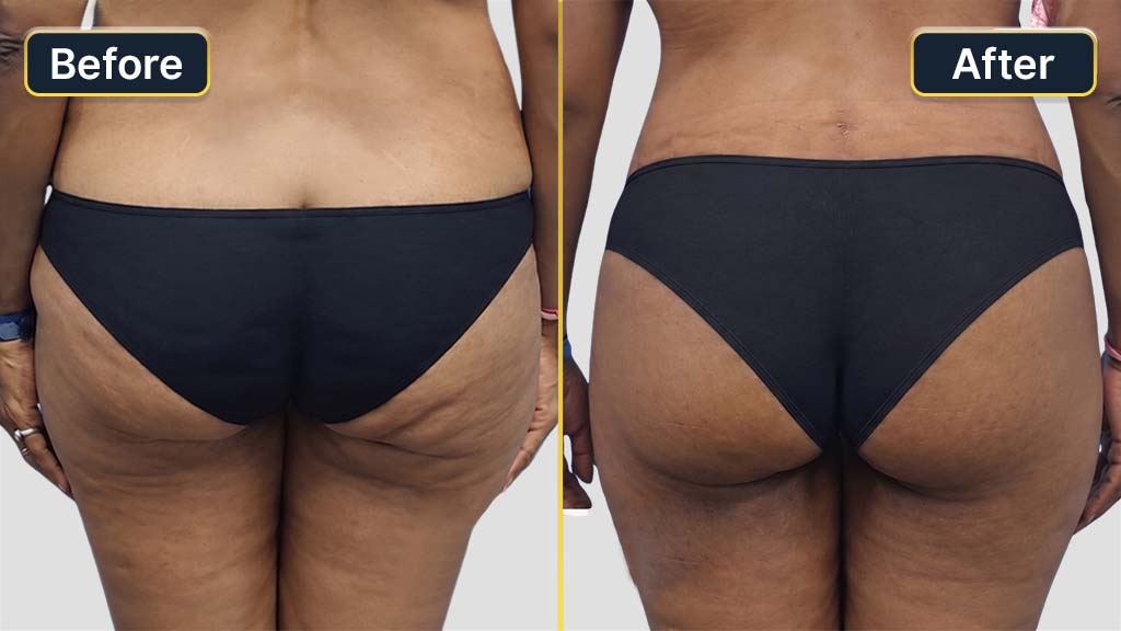 Liposuction Before and After
