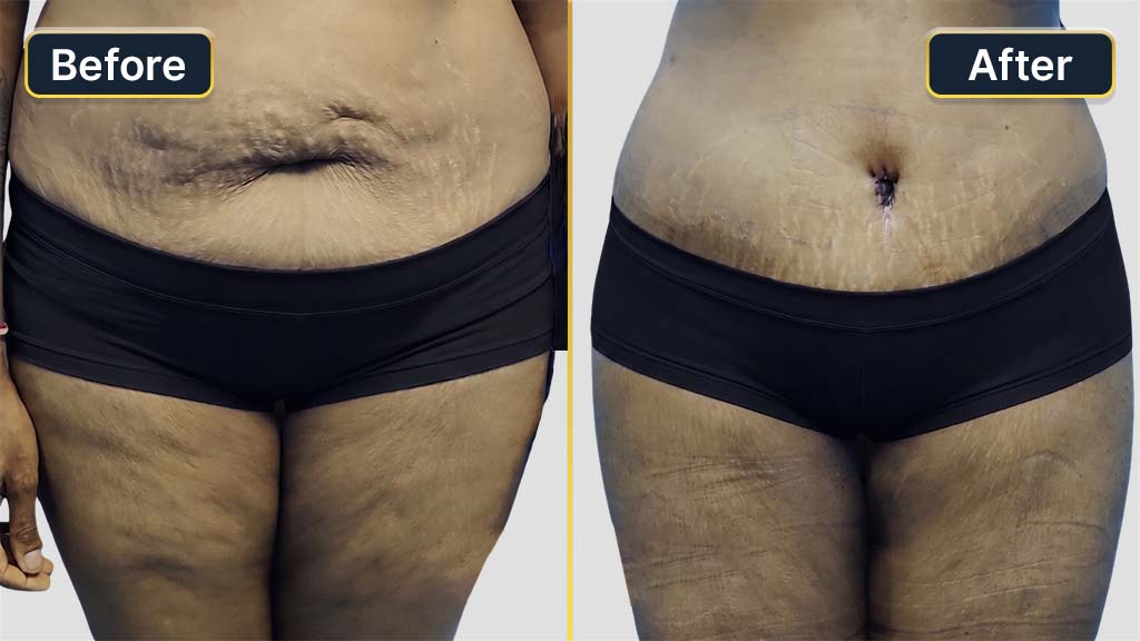 Liposuction Before and After