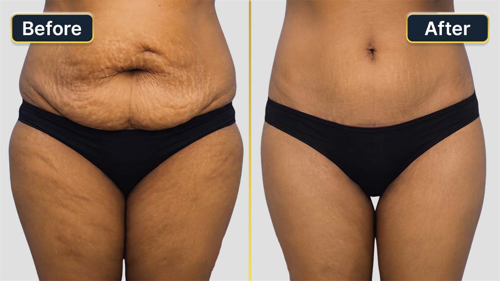 Liposuction Before and After