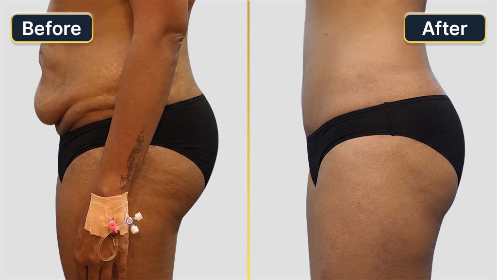 Liposuction Before and After