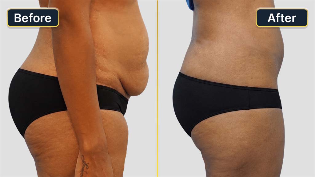 Liposuction Before and After