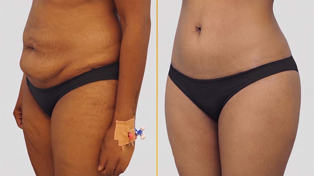 Liposuction Before and After
