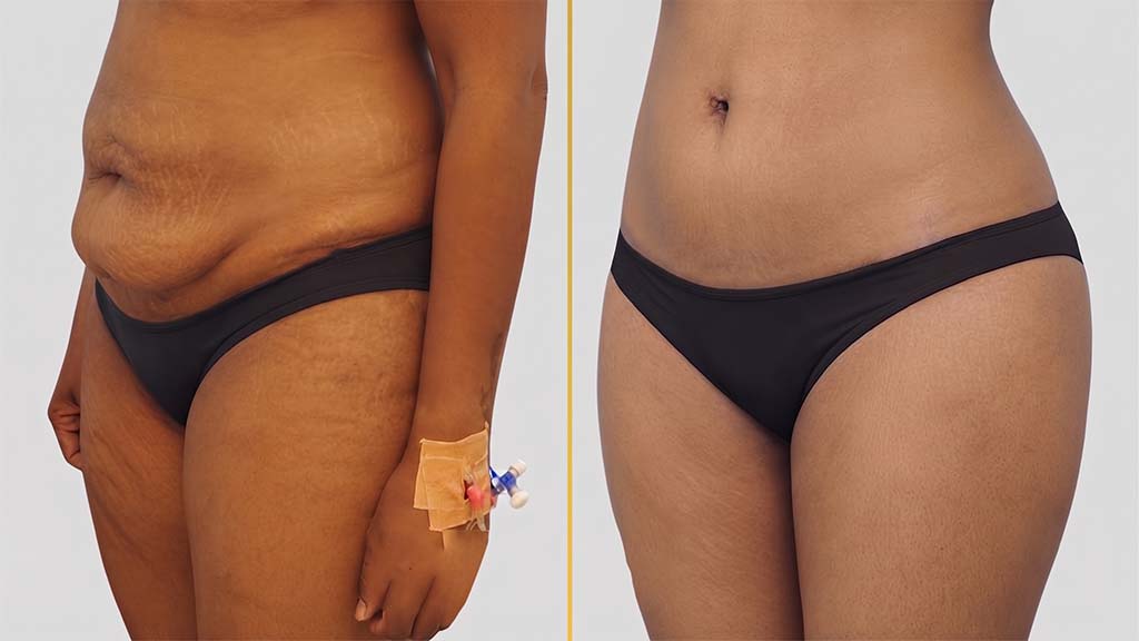Liposuction Before and After