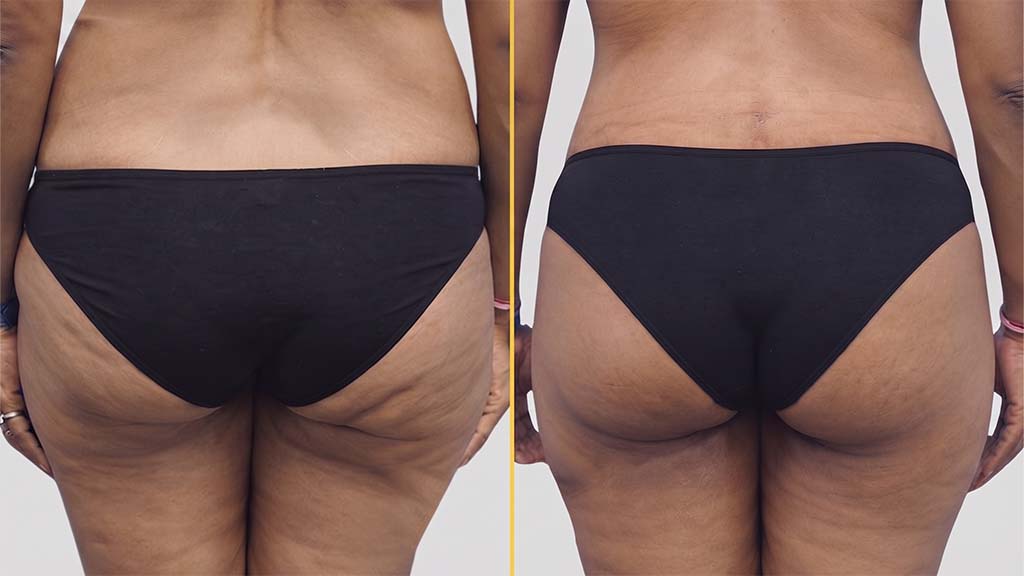 Liposuction Before and After