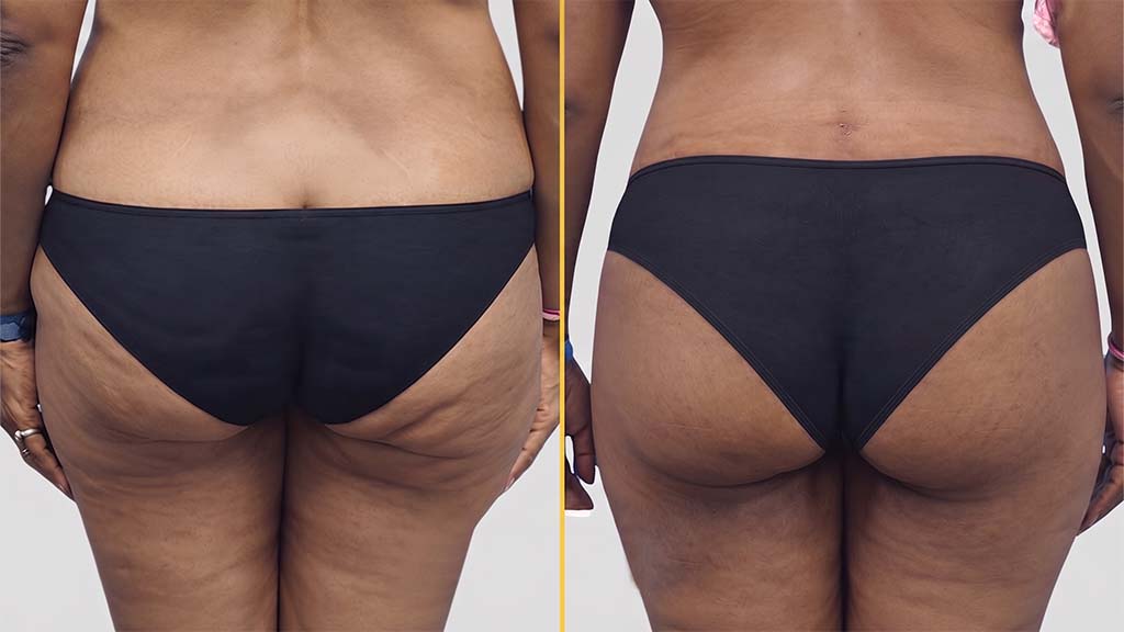 Liposuction Before and After