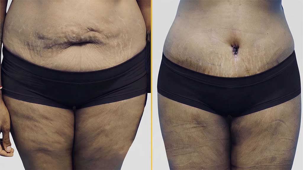 Liposuction Before and After