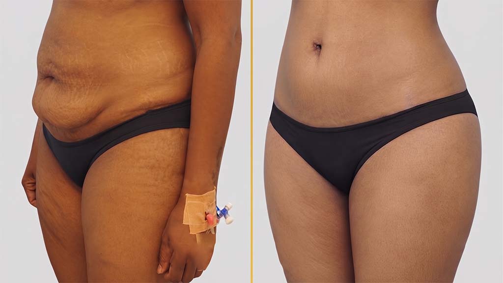 Liposuction Before and After