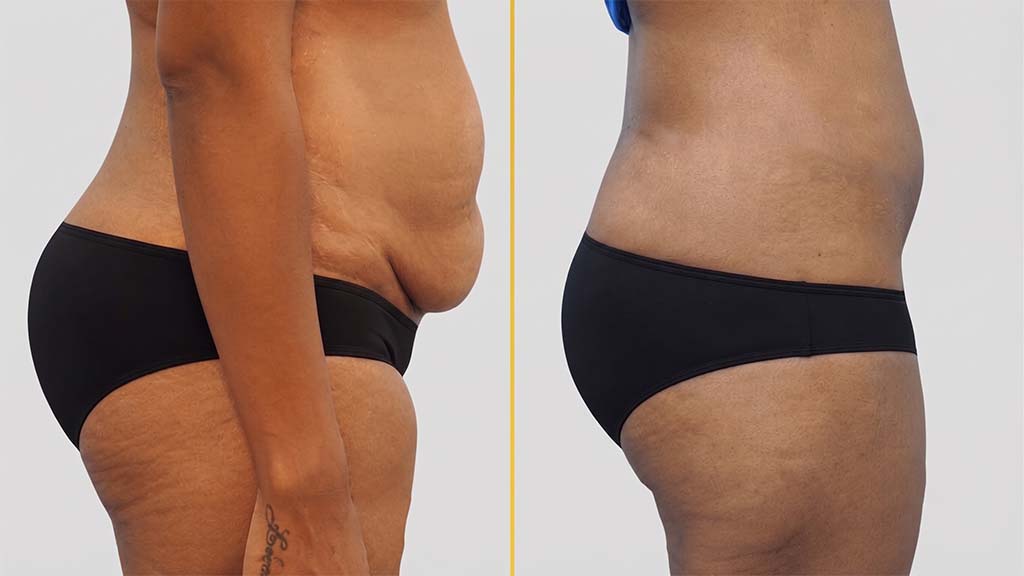 Liposuction Before and After