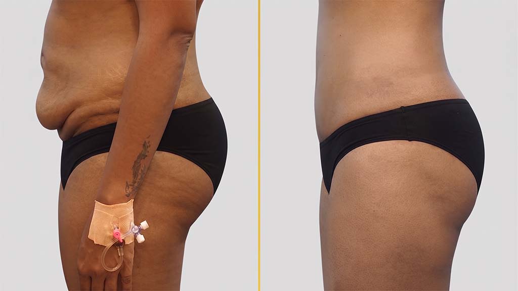 Liposuction Before and After