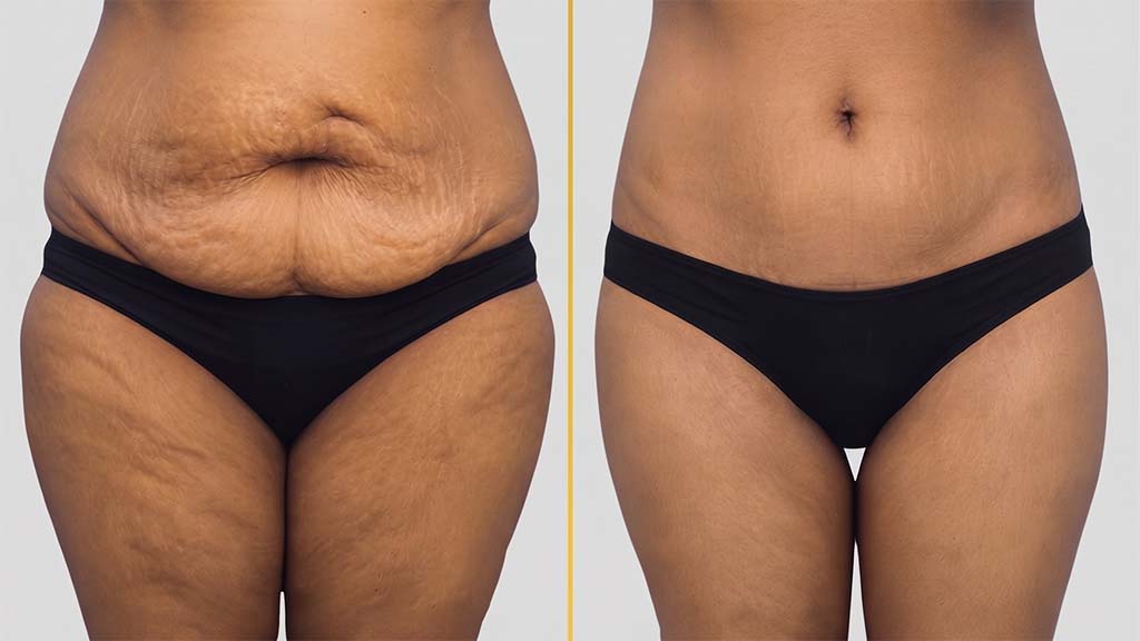 Liposuction Before and After