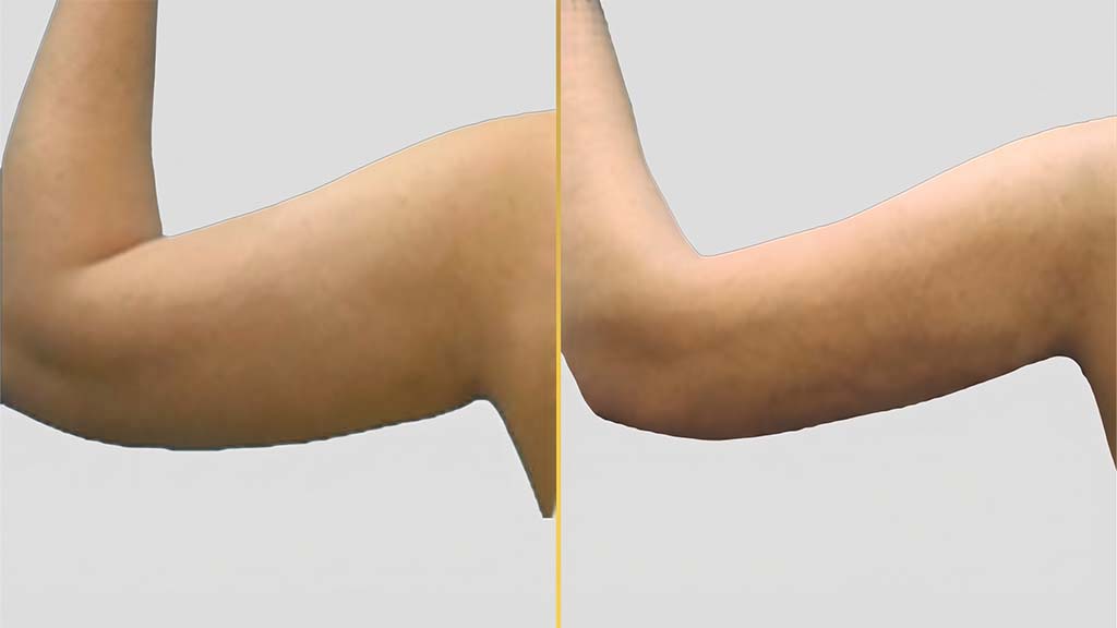 Arm Contouring Before and After