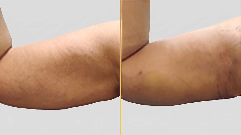 Arm Contouring Before and After