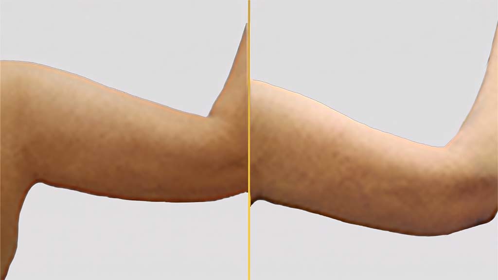 Arm Contouring Before and After