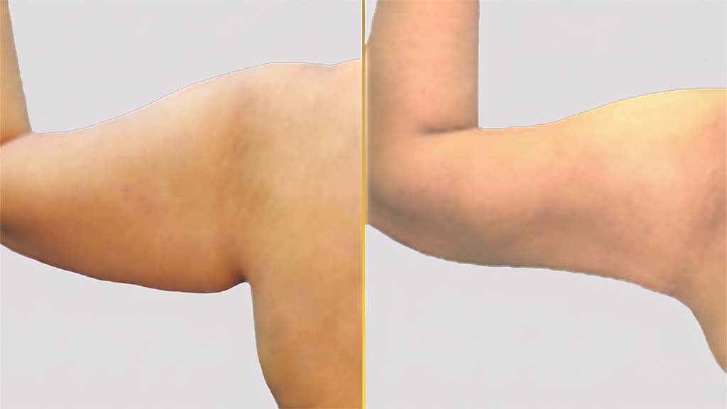 Arm Contouring Before and After