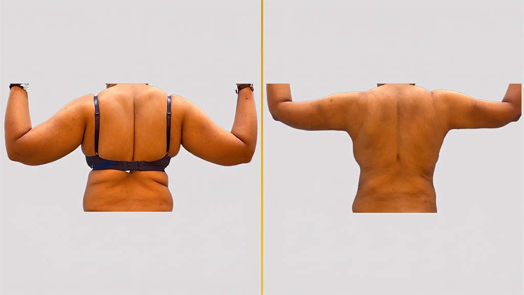 Arm Contouring Before and After