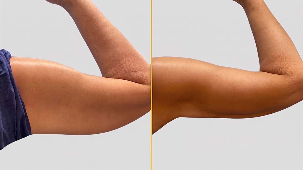 Arm Contouring Before and After
