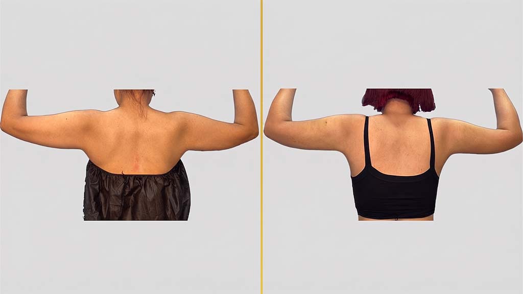 Arm Contouring Before and After
