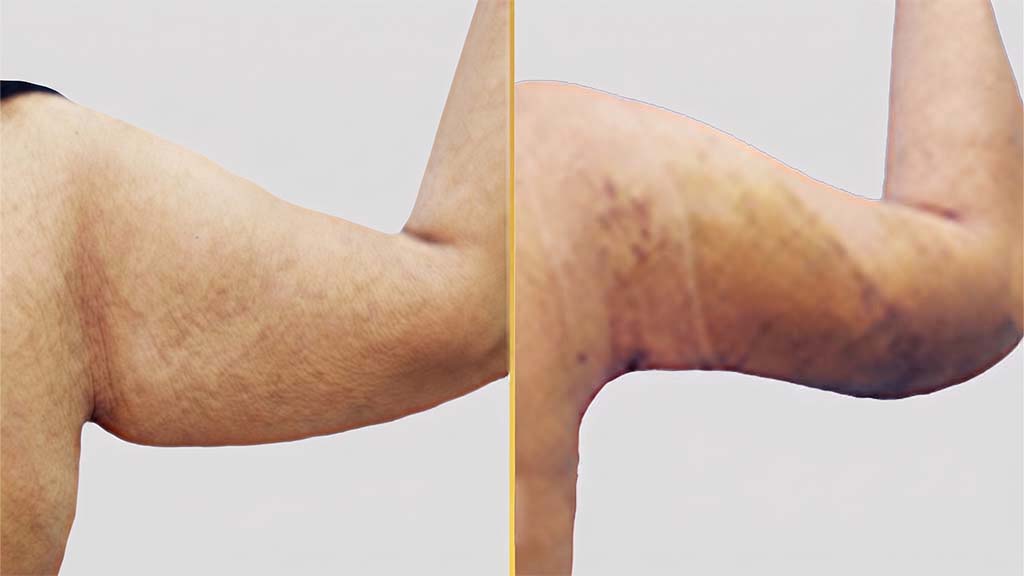 Arm Contouring Before and After