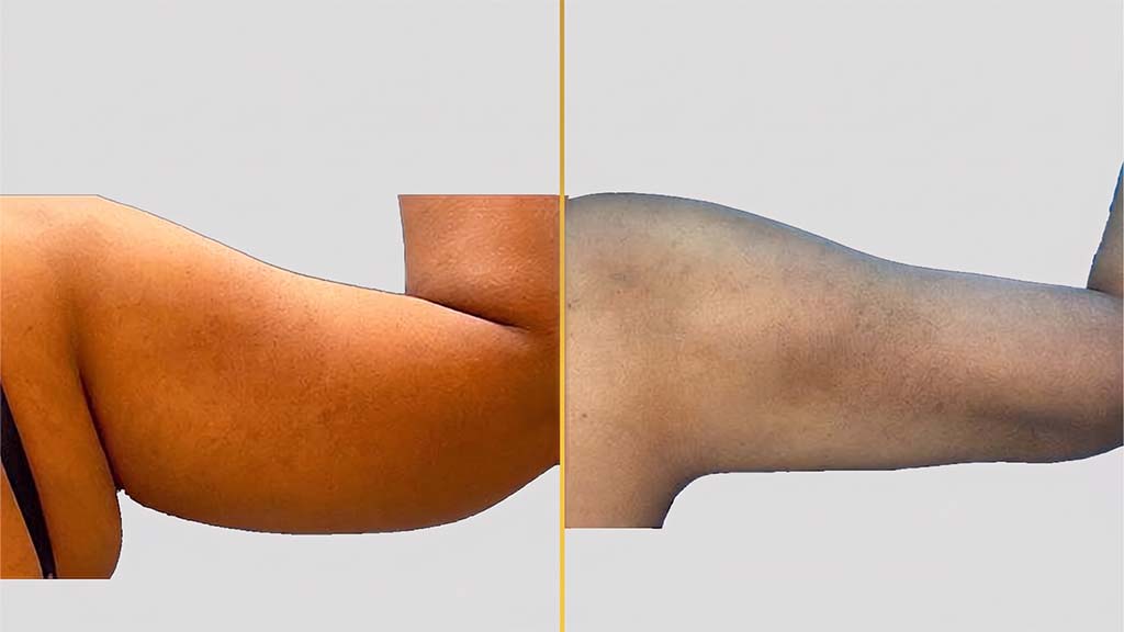 Arm Contouring Before and After