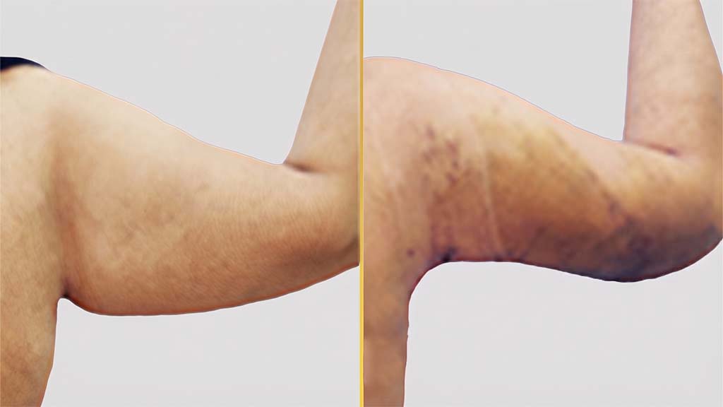 Arm Contouring Before and After