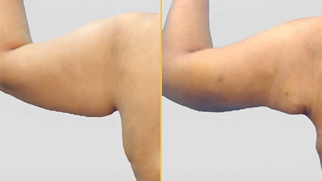 Arm Contouring Before and After