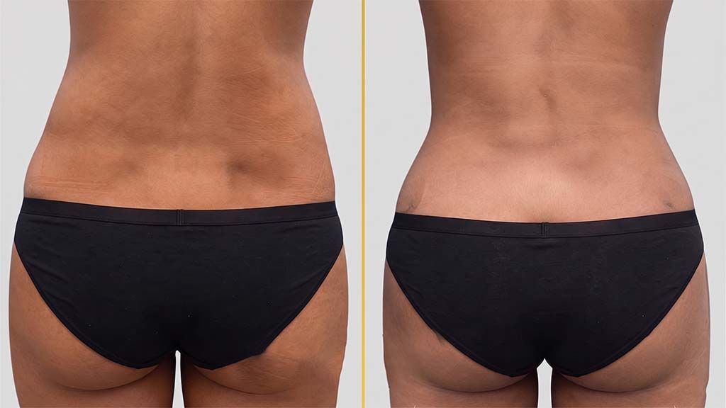 Liposuction Before and After
