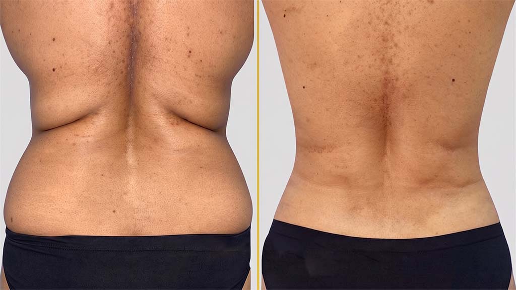 Liposuction Before and After