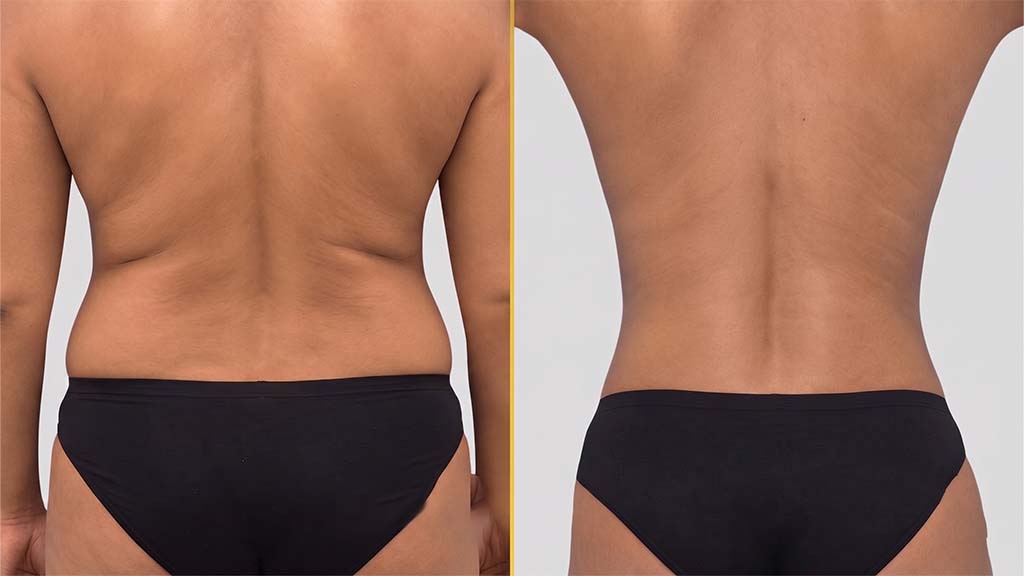 Liposuction Before and After