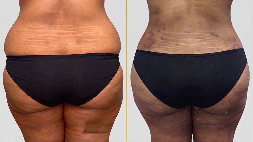 Liposuction Before and After