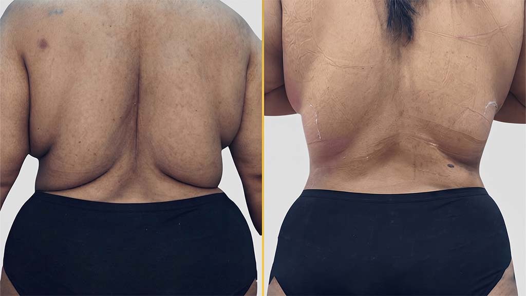 Liposuction Before and After