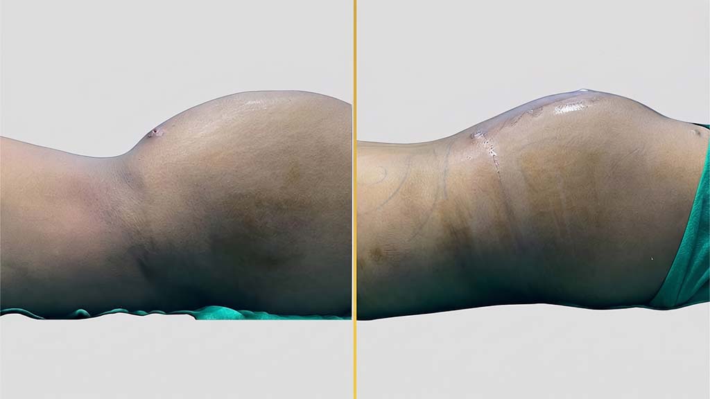 Liposuction Before and After