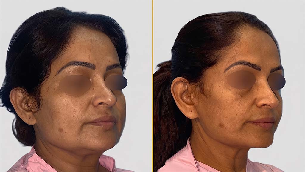 Face Lift Before and After