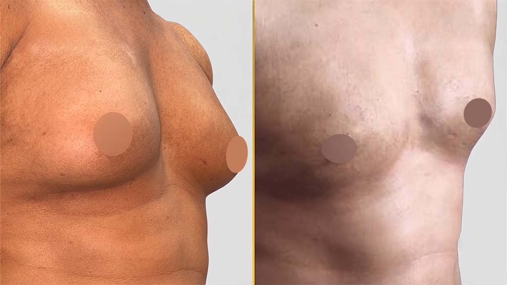 Gynecomastia (Male Boobs) Before and After