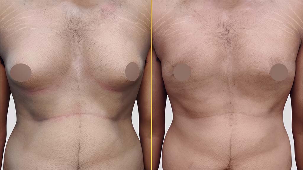 Gynecomastia (Male Boobs) Before and After
