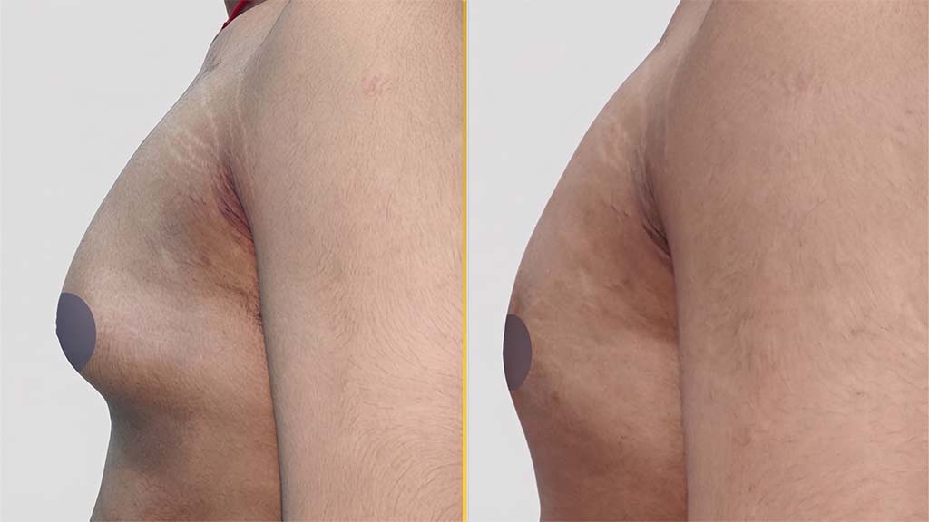 Gynecomastia (Male Boobs) Before and After