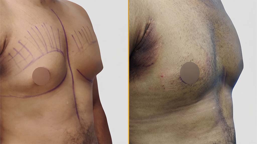 Gynecomastia (Male Boobs) Before and After