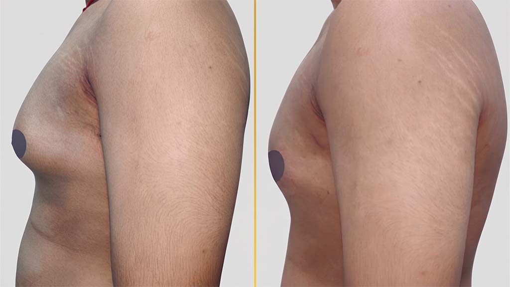 Gynecomastia (Male Boobs) Before and After
