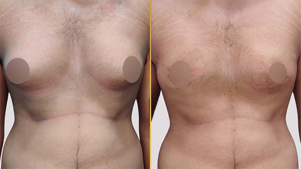 Gynecomastia (Male Boobs) Before and After