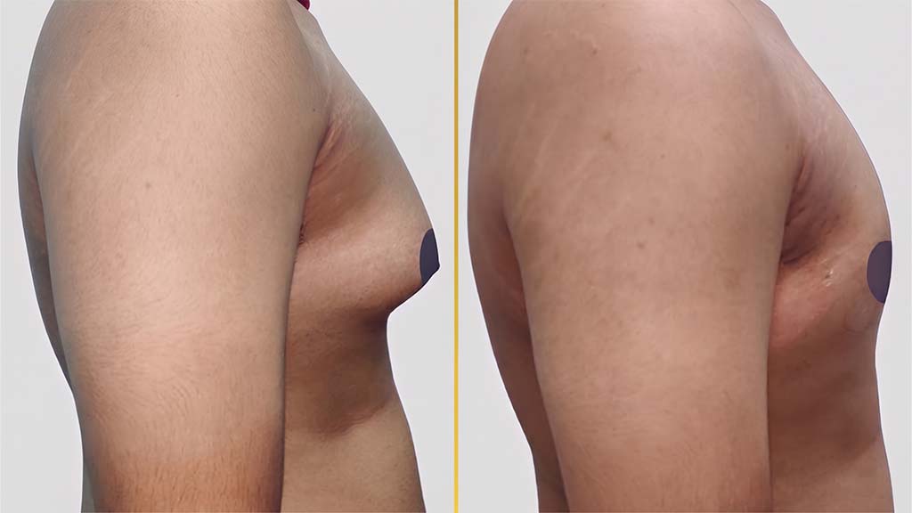 Gynecomastia (Male Boobs) Before and After