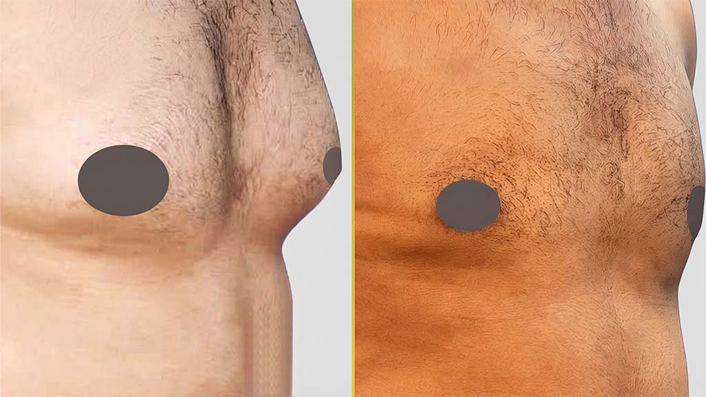 Gynecomastia (Male Boobs) Before and After