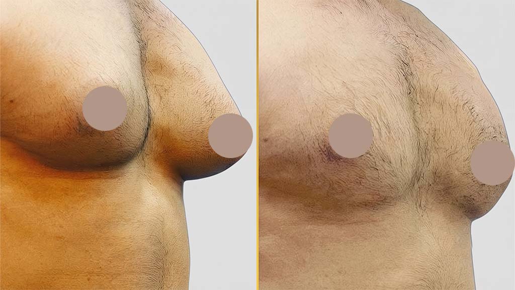 Gynecomastia (Male Boobs) Before and After