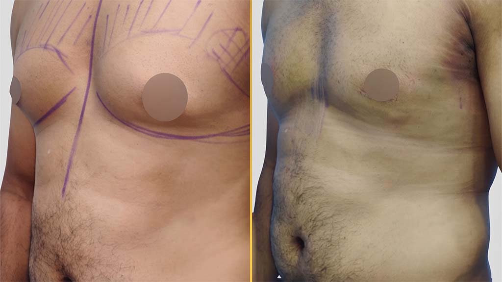 Gynecomastia (Male Boobs) Before and After